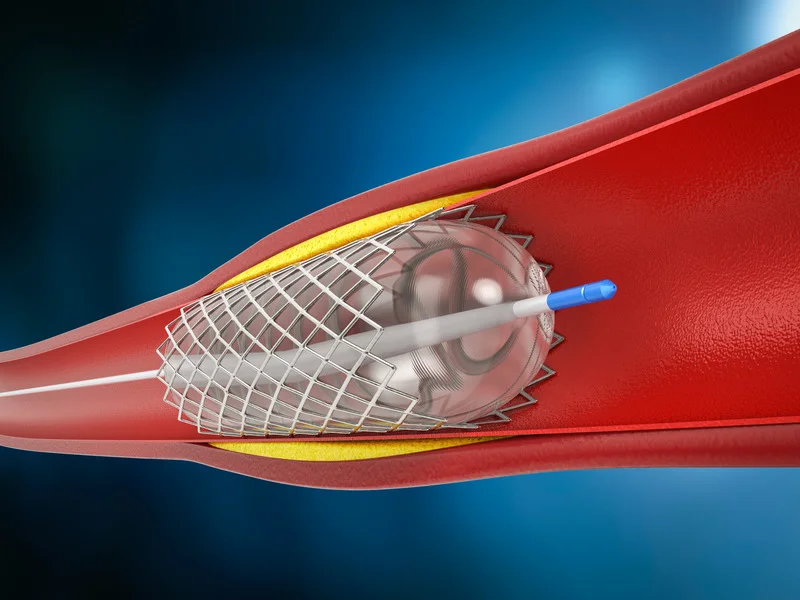 Angioplasty (Stent) in India