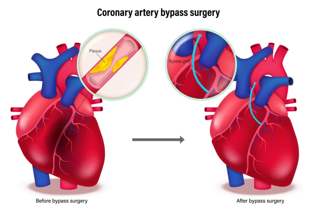 Bypass Surgery (CABG) in India