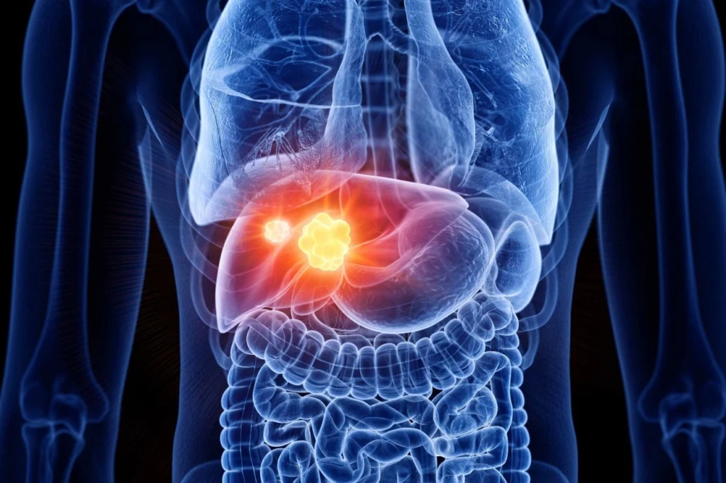 Liver Cancer Treatment in India